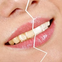 Affordable Teeth Whitening Cardiff 148171 Image 0