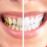 Affordable Teeth Whitening Cardiff 148171 Image 4