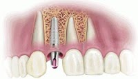 Cosmetic Dentist and Dental Implants Norwich   Dr Ori Michaeli 138006 Image 2
