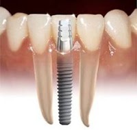 Cosmetic Dentist and Dental Implants Norwich   Dr Ori Michaeli 138006 Image 4