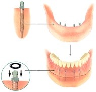 Cosmetic Dentist and Dental Implants Norwich   Dr Ori Michaeli 138006 Image 7