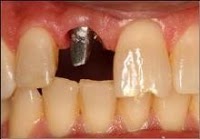 Dental Implants Yorkshire 150483 Image 0