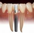 SS dental Innovations 156252 Image 2