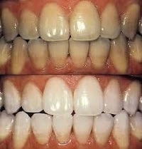 Teeth Whitening Cardiff 147493 Image 3