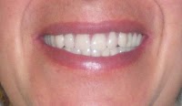 Cosmetic Denture Design, Teeth Whitening and Fangs by Speedy Denture Repairs LTD 147028 Image 0
