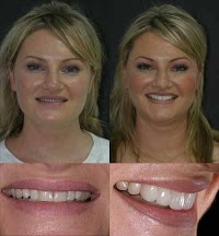 Dr Raj Ahlowalia. Smile makeovers, veneers and teeth whitening, Biggleswade, Beds 144852 Image 8