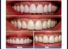 Leeds teeth whitening cosmetic dentist dental specialist invisalign braces 141349 Image 3