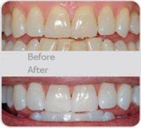 Polished Mobile Teeth Whitening 153837 Image 1