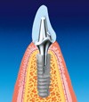 Soni Dental Implants 153680 Image 1