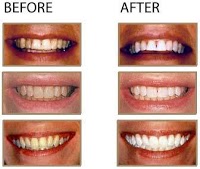 Teeth Whitening London 150594 Image 2