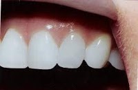 whitensmile   Professhional Laser Teeth Whitening 143438 Image 2
